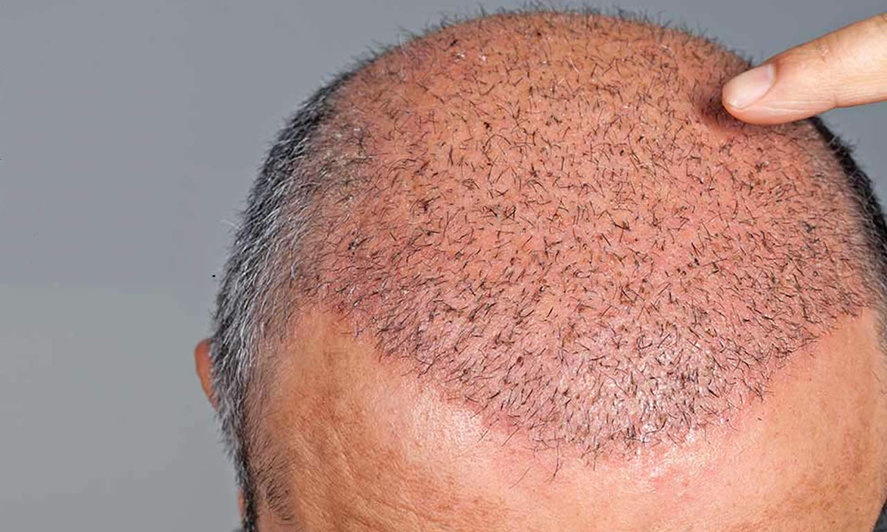HAARTRANSPLANTATION